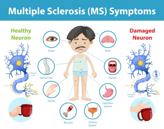 Esclerosis Múltiple: Una Enfermedad del Sistema Nervioso Central ...